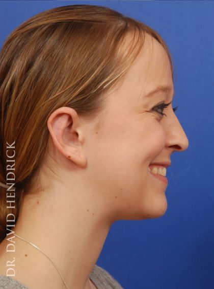 Otoplasty Before & After Patient #9031