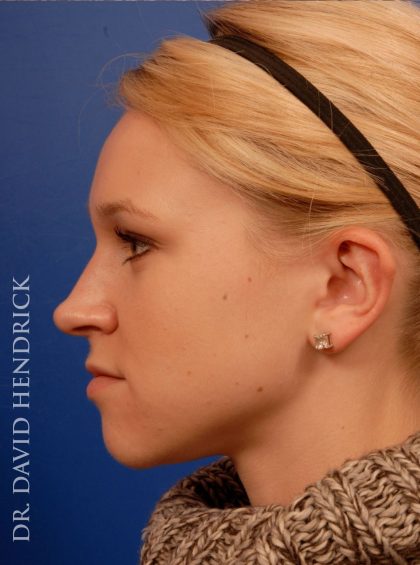 Otoplasty Before & After Patient #9038