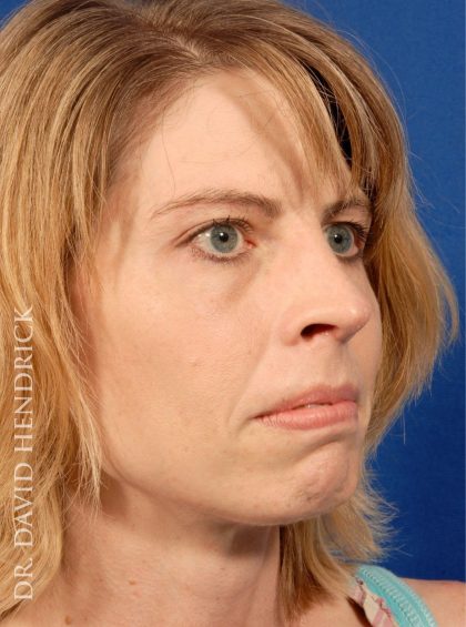 Rhinoplasty Before & After Patient #9045