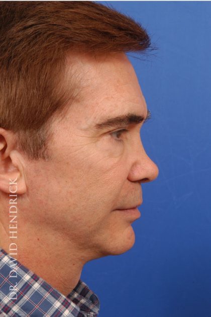 Facelift Before & After Patient #8873