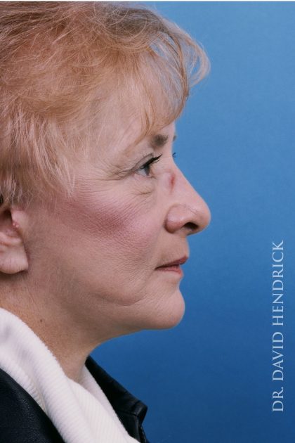 Facelift Before & After Patient #8819