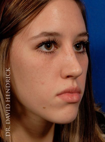 Rhinoplasty Before & After Patient #8948