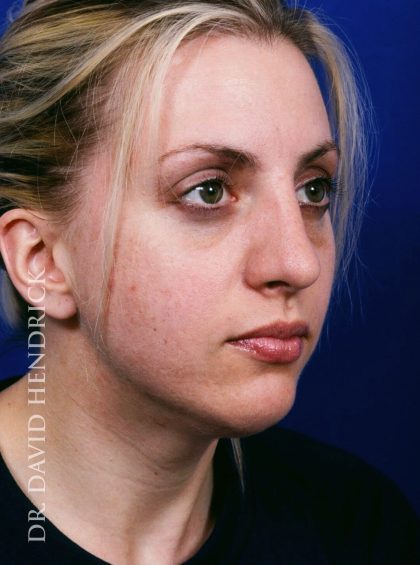 Face Implants Before & After Patient #8890