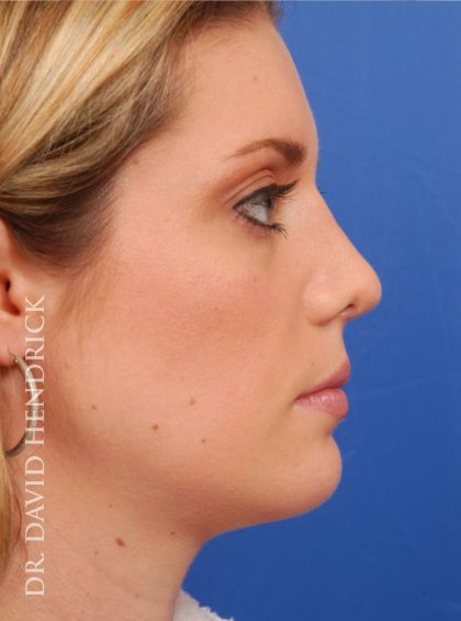 Face Implants Before & After Patient #8875