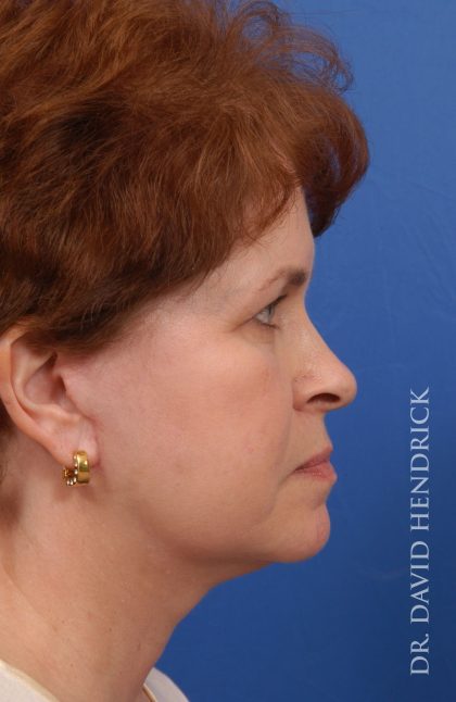 Facelift Before & After Patient #8857