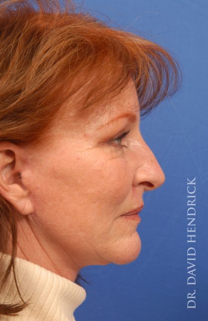 Facelift Before & After Patient #8859