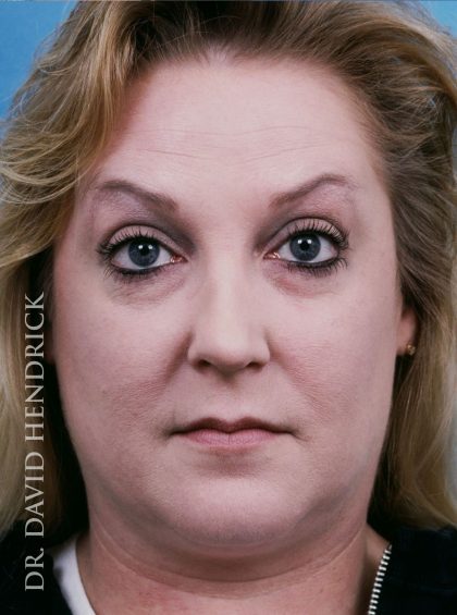 Rhinoplasty Before & After Patient #8967