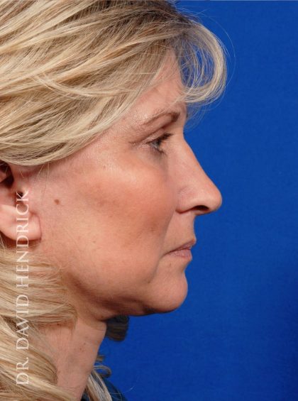 Deep Plane Facelift Before & After Patient #8974