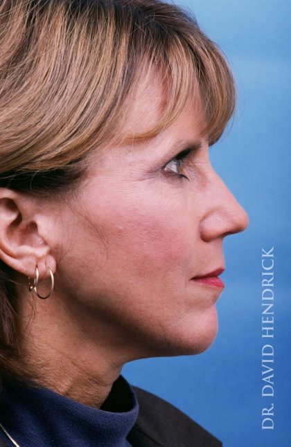 Facelift Before & After Patient #8895