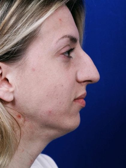 Chin Implant Before & After Patient #8981