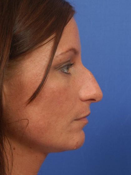 Rhinoplasty Before & After Patient #8931