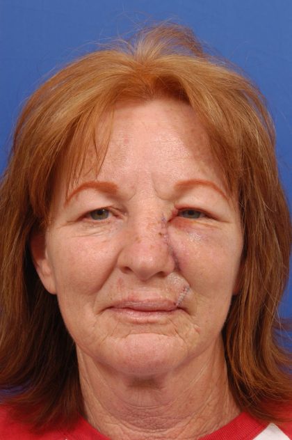 Facelift Before & After Patient #8859