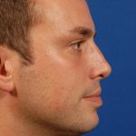 Rhinoplasty Before & After Patient #8995