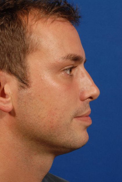 Rhinoplasty Before & After Patient #8995