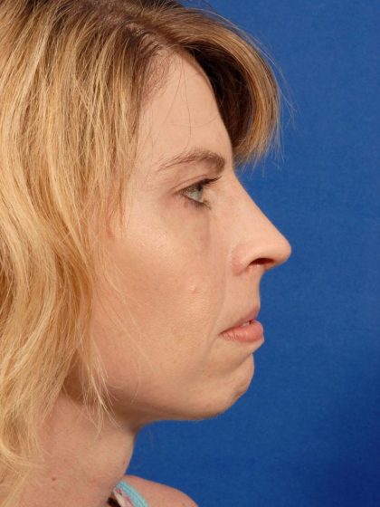 Rhinoplasty Before & After Patient #9045
