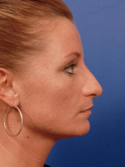 Rhinoplasty Before & After Patient #8931