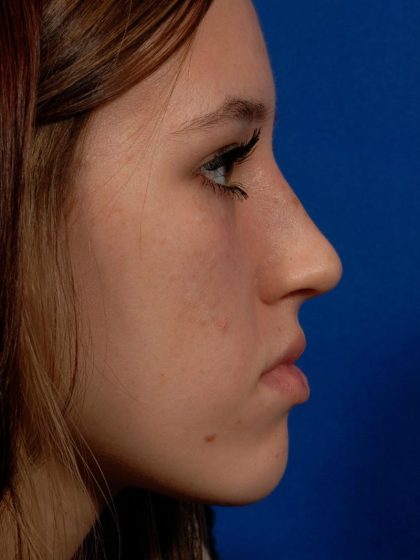 Rhinoplasty Before & After Patient #8948