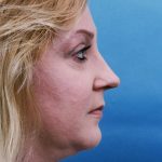 Rhinoplasty Before & After Patient #8967