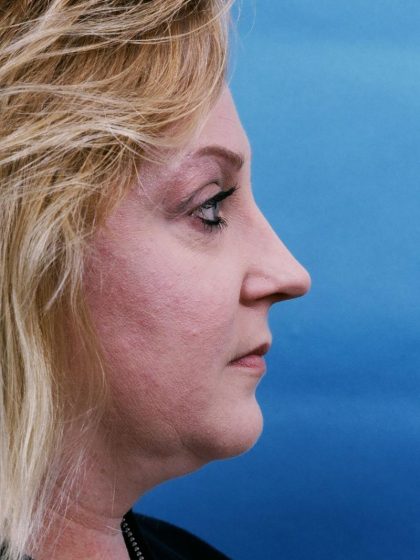Rhinoplasty Before & After Patient #8967
