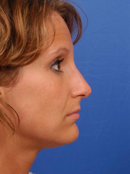 Rhinoplasty Before & After Patient #8941