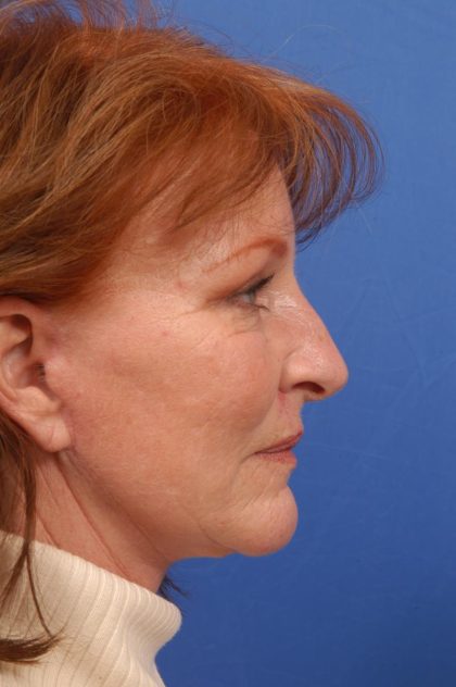 Facelift Before & After Patient #8859