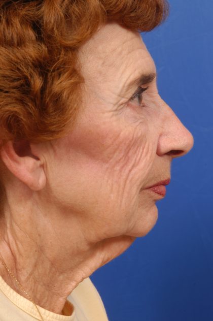 Chin Implant Before & After Patient #8962