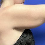 Arm Lift Before & After Patient #9107