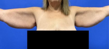 Arm Lift Before & After Patient #9106