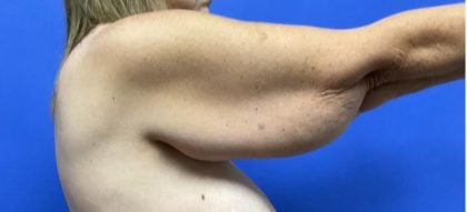 Arm Lift Before & After Patient #9106