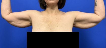Arm Lift Before & After Patient #9108
