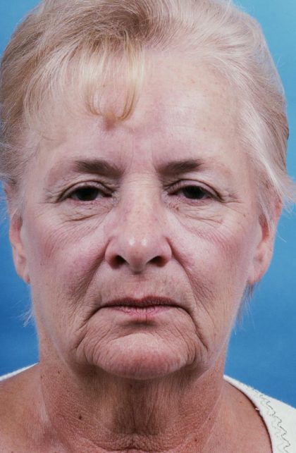Facelift Before & After Patient #8819