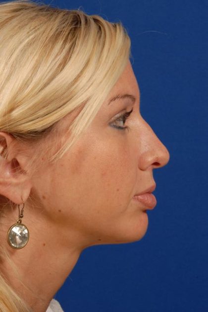 Face Implants Before & After Patient #8912