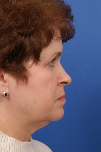 Facelift Before & After Patient #8857