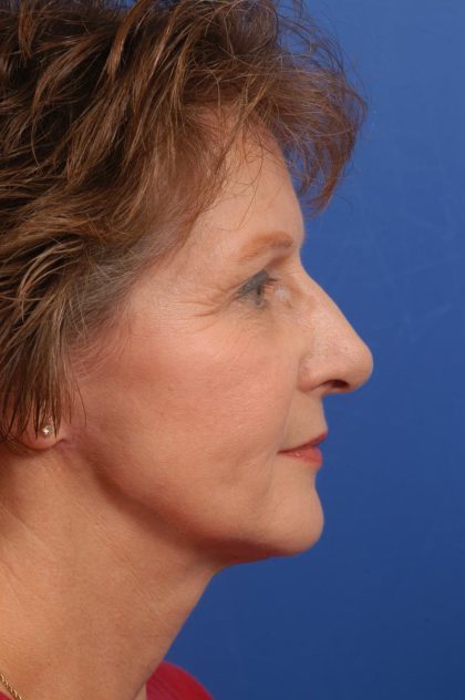 Facelift Before & After Patient #8847