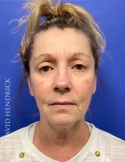 Brow Lift Before & After Patient #9363