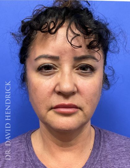 Facelift Before & After Patient #9306