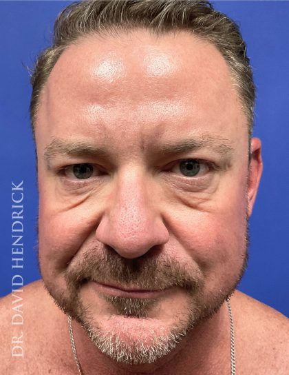 Brow Lift Before & After Patient #9304