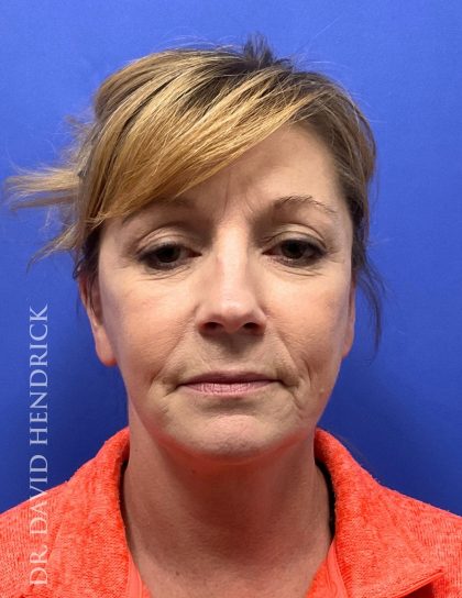 Brow Lift Before & After Patient #9363