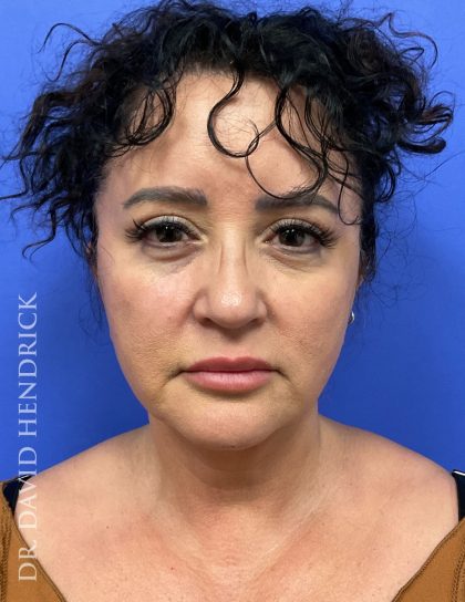 Facelift Before & After Patient #9306