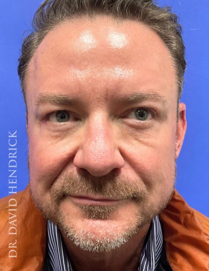 Brow Lift Before & After Patient #9304