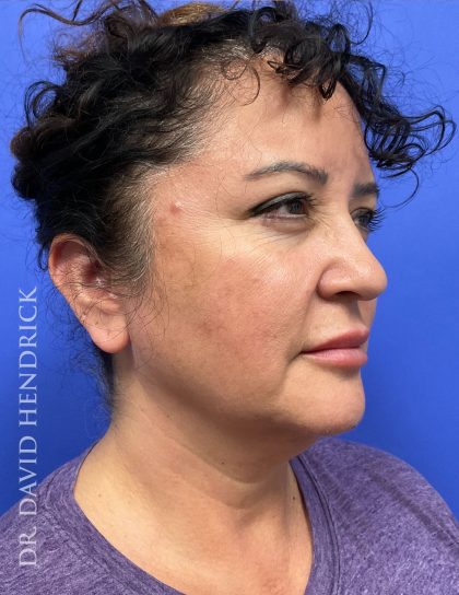 Facelift Before & After Patient #9306