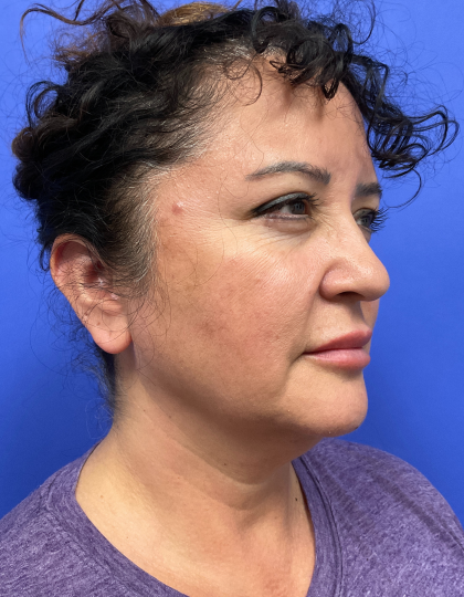 Neck Lift Before & After Patient #9306