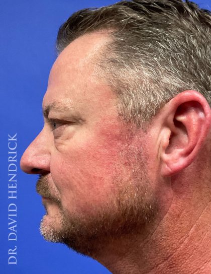 Brow Lift Before & After Patient #9304