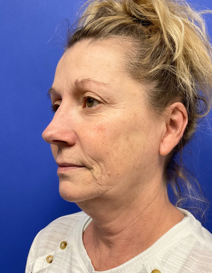 Facelift Before & After Patient #9362