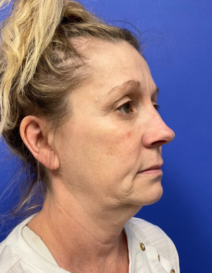 Neck Lift Before & After Patient #9363