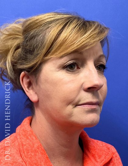 Brow Lift Before & After Patient #9363