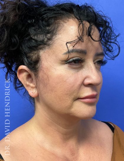 Facelift Before & After Patient #9306