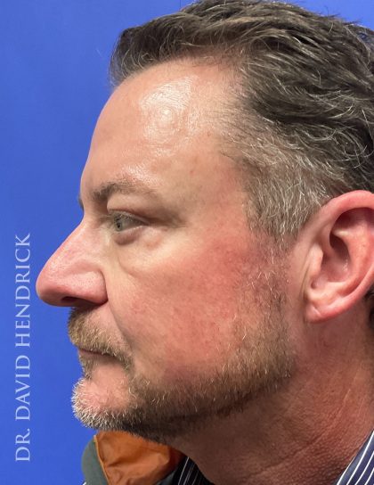 Brow Lift Before & After Patient #9304