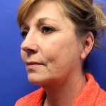 Facelift Before & After Patient #9362
