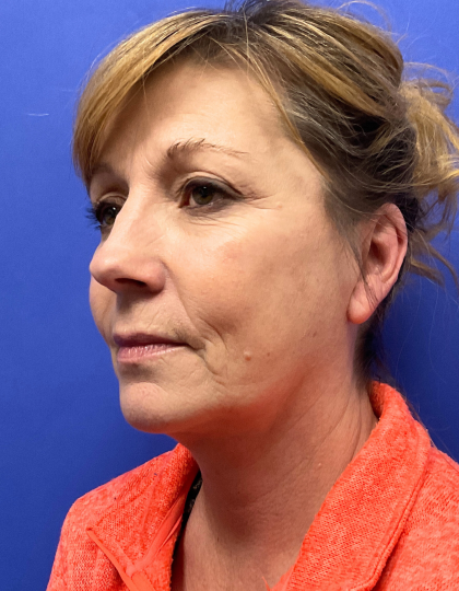 Facelift Before & After Patient #9362